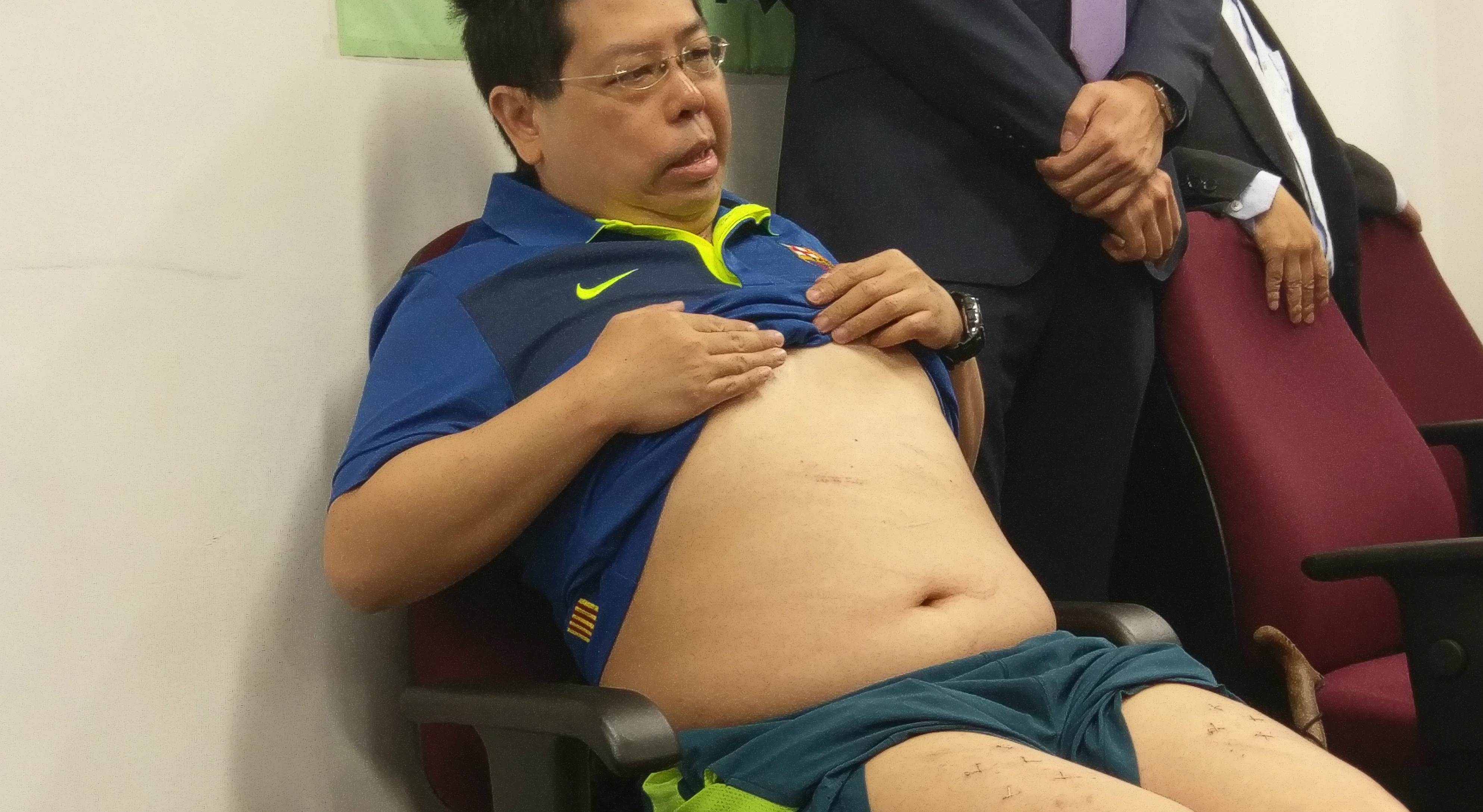 Howard Lam, accompanied by Democratic Party officials, shows the wounds he said suspected mainland security agents inflicted on him during his alleged abduction and torture. Photo: HKEJ Howard Lam, accompanied by Democratic Party officials, shows the wounds he said suspected mainland security agents inflicted on him during his alleged abduction and torture. Photo: HKEJ