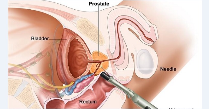 Diagnosis of prostate cancer involves an ultrasound probe via a patient's rectum for up-close examination of the prostate. Photo: National Cancer Institute Diagnosis of prostate cancer involves an ultrasound probe via a patient's rectum for up-close examination of the prostate. Photo: National Cancer Institute
