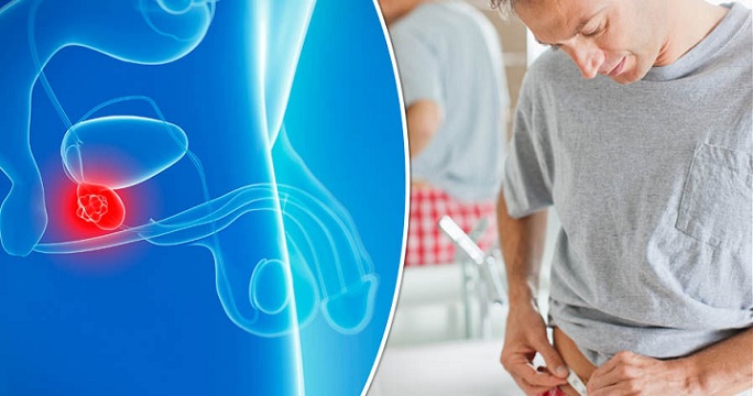 September is the Global Prostate Cancer Awareness Month. Prostate cancer accounts for more than 11 percent of all new cancer cases in Hong Kong men. Photo: Internet September is the Global Prostate Cancer Awareness Month. Prostate cancer accounts for more than 11 percent of all new cancer cases in Hong Kong men. Photo: Internet