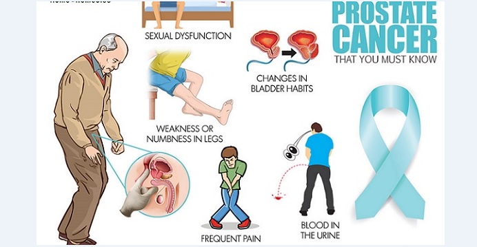 Never overlook these common symptoms of possible prostate cancer for early diagnosis. Photo: top10homeremedies Never overlook these common symptoms of possible prostate cancer for early diagnosis. Photo: top10homeremedies