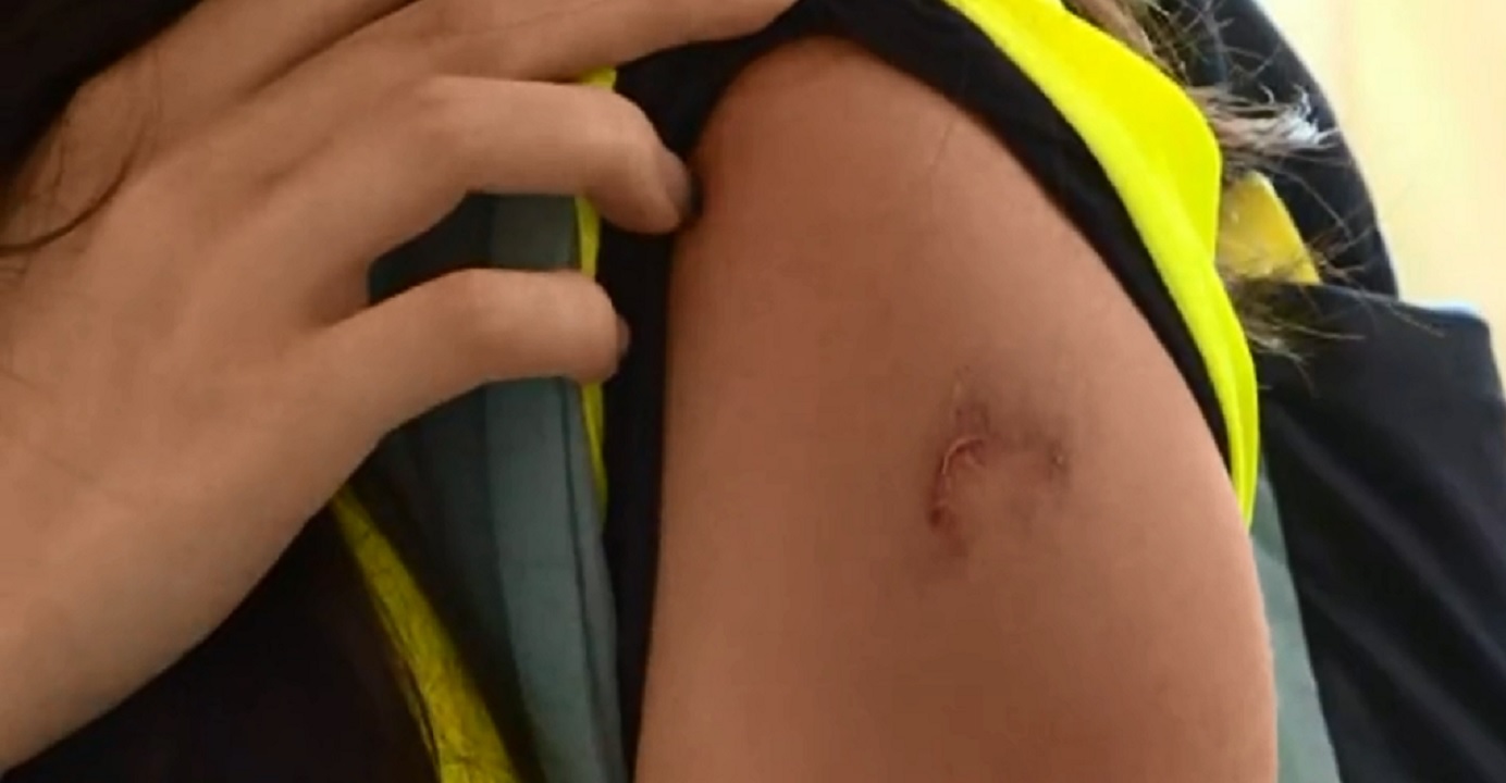 A Now TV reporter suffered burn injuries on her left upper arm after she was struck by a canister of tear gas in Tsuen Wan on Sunday. Photo: Now TV video/screenshot A Now TV reporter suffered burn injuries on her left upper arm after she was struck by a canister of tear gas in Tsuen Wan on Sunday. Photo: Now TV video/screenshot