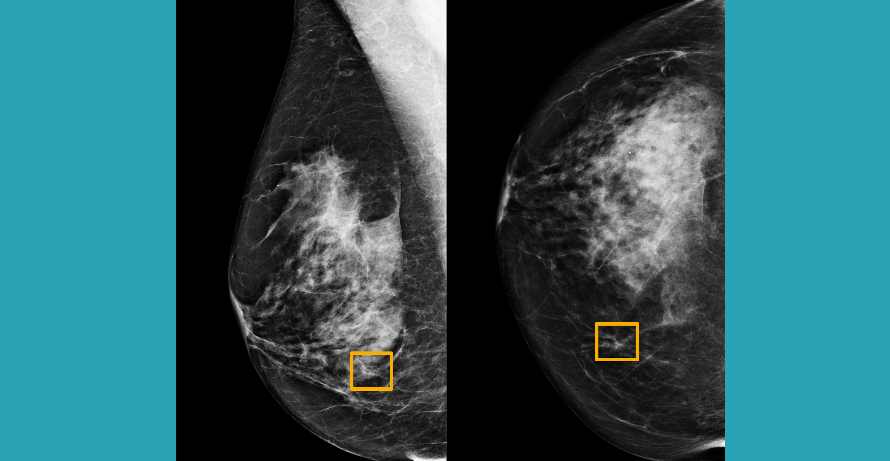 The yellow box indicates where an AI system found cancer hiding inside breast tissue. Photo: Northwestern University/Handout via Reuters The yellow box indicates where an AI system found cancer hiding inside breast tissue. Photo: Northwestern University/Handout via Reuters