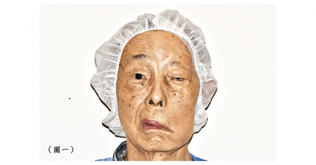 左面顏面神經麻痹的情況。（作者圖片）